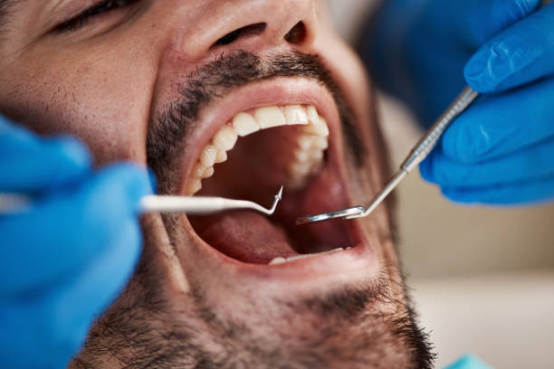 Best Emergency Treatment for Dental Infections or Abscesses in Cherry Hill, VA